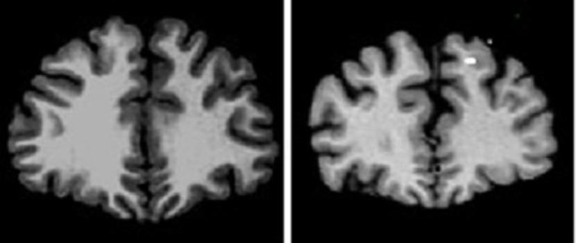 cerveau